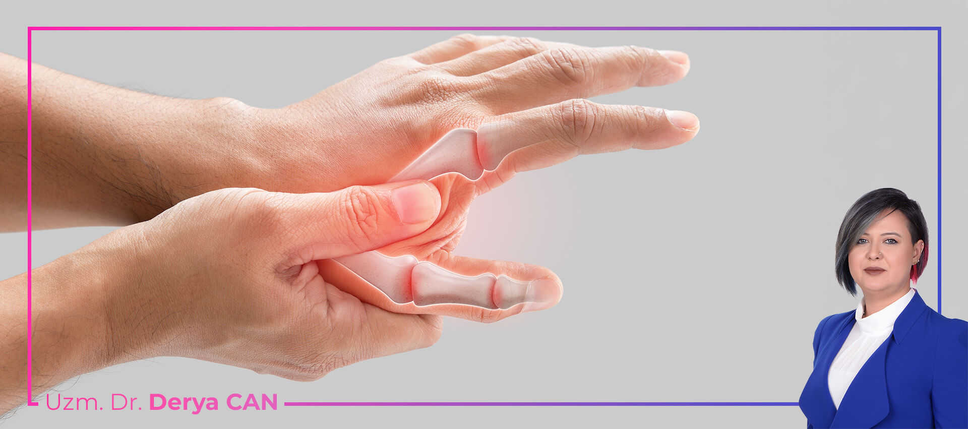 El parmak kireçlenmesi nedeniyle eklem ağrısı ve iltihaplanma görselleştirmesi