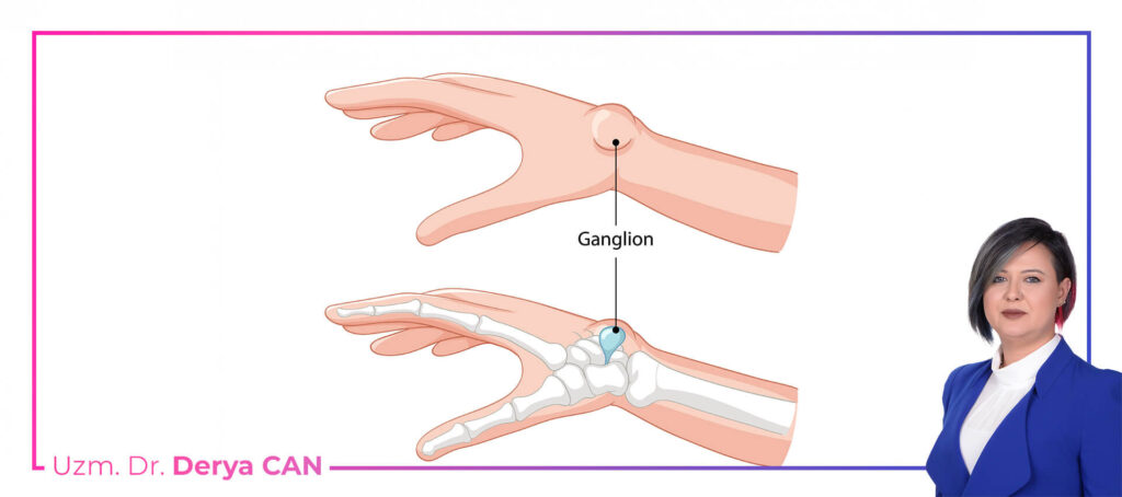 Ganglion kisti nedir - Dr. Derya Can