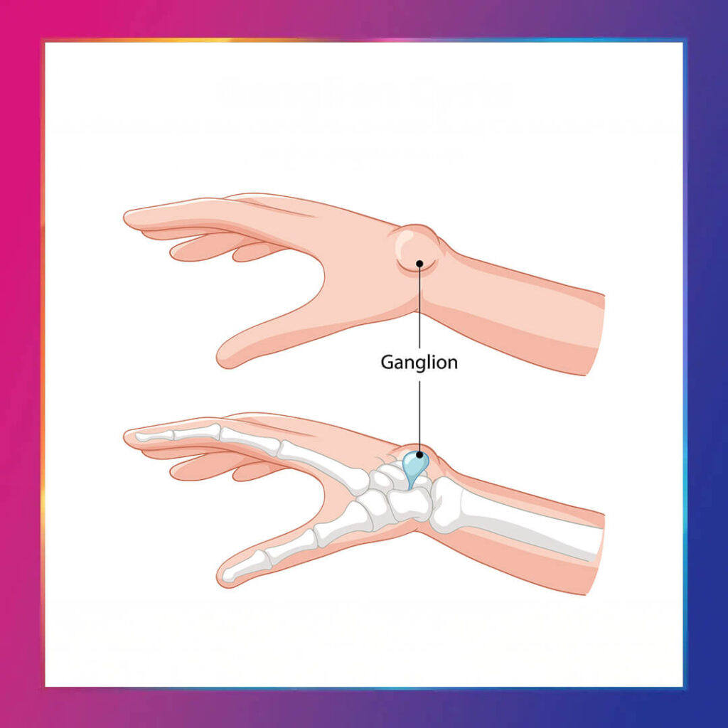 Ganglion kisti tedavisi yöntemleri - Dr. Derya Can