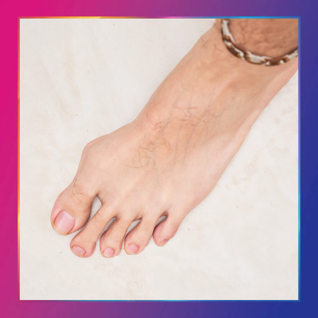 Halluks Valgus (Başparmak Çıkıntısı) Tedavisi Yöntemleri