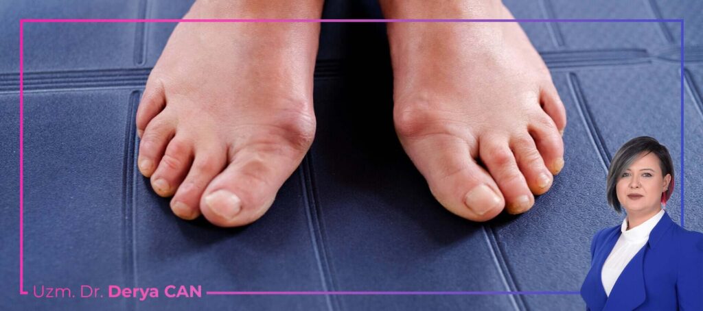 Halluks Valgus (Başparmak Çıkıntısı) Tedavisi 1 Halluks Valgus (Başparmak Çıkıntısı) Tedavisi Nasıl Yapılır?