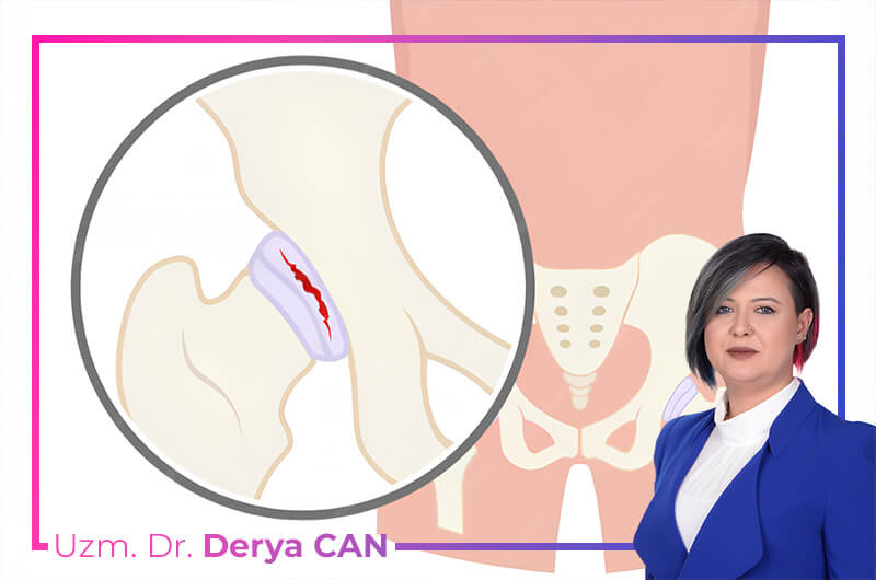 Dr. Derya Can - Kalça Labrum Yırtığı Nedir