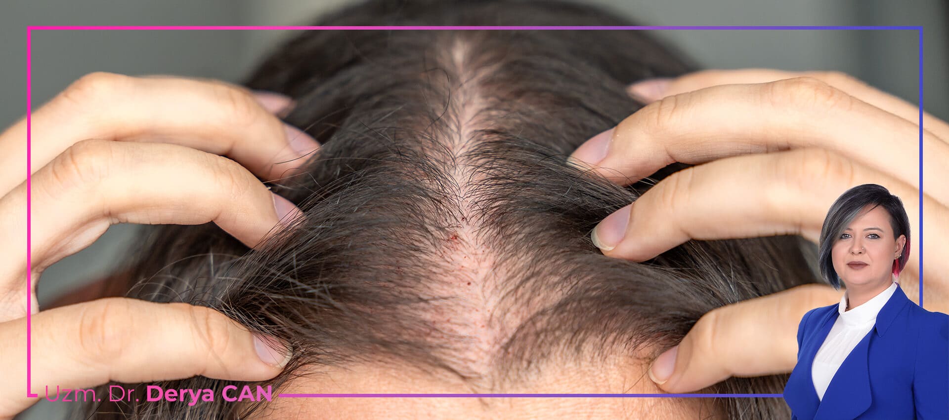 Kıl kökü kuvvetlendirme hakkında bilgilendirme