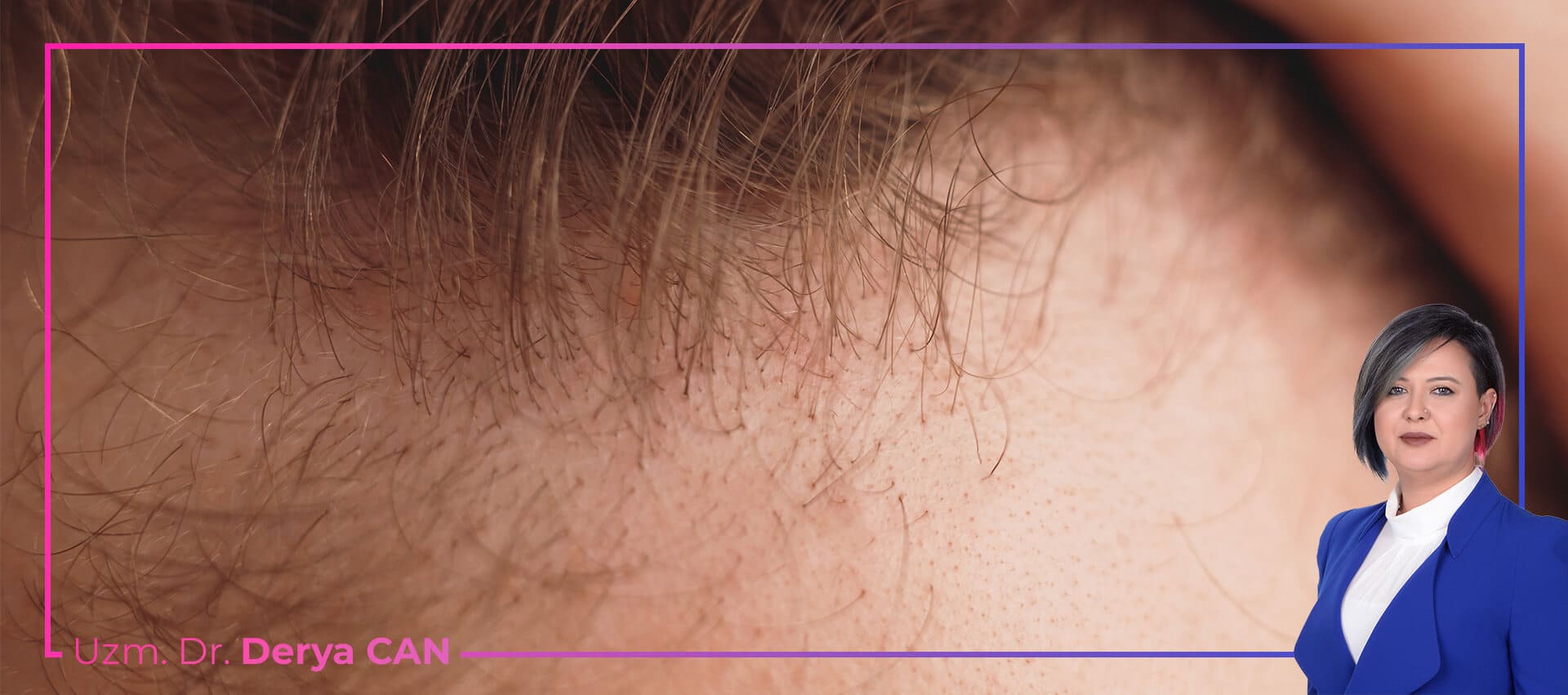 Kıl köklerini kuvvetlendirme için uygulanan tedavi yöntemleri