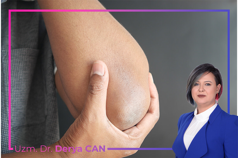 Tendinit nedeniyle şişmiş ve ağrılı eklem bölgesi