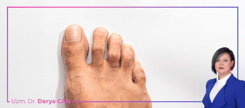 Çekiç parmak deformitesi proloterapi tedavisi