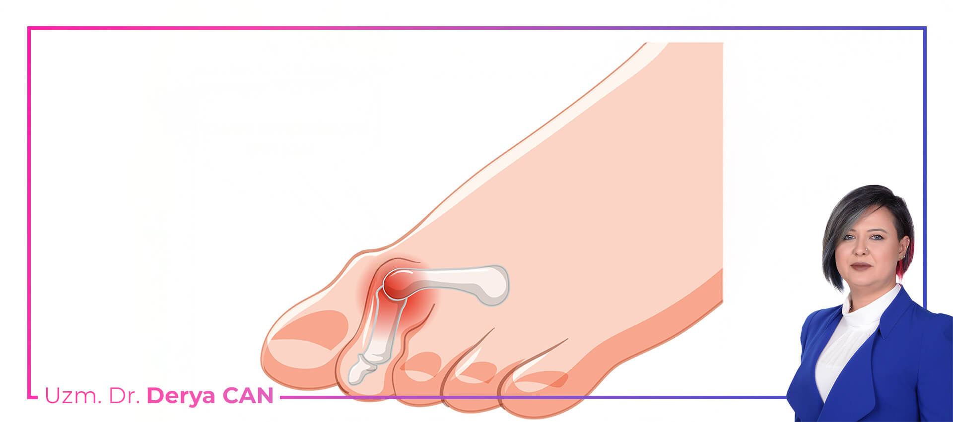 Çekiç parmak deformitesi prolozon tedavisi