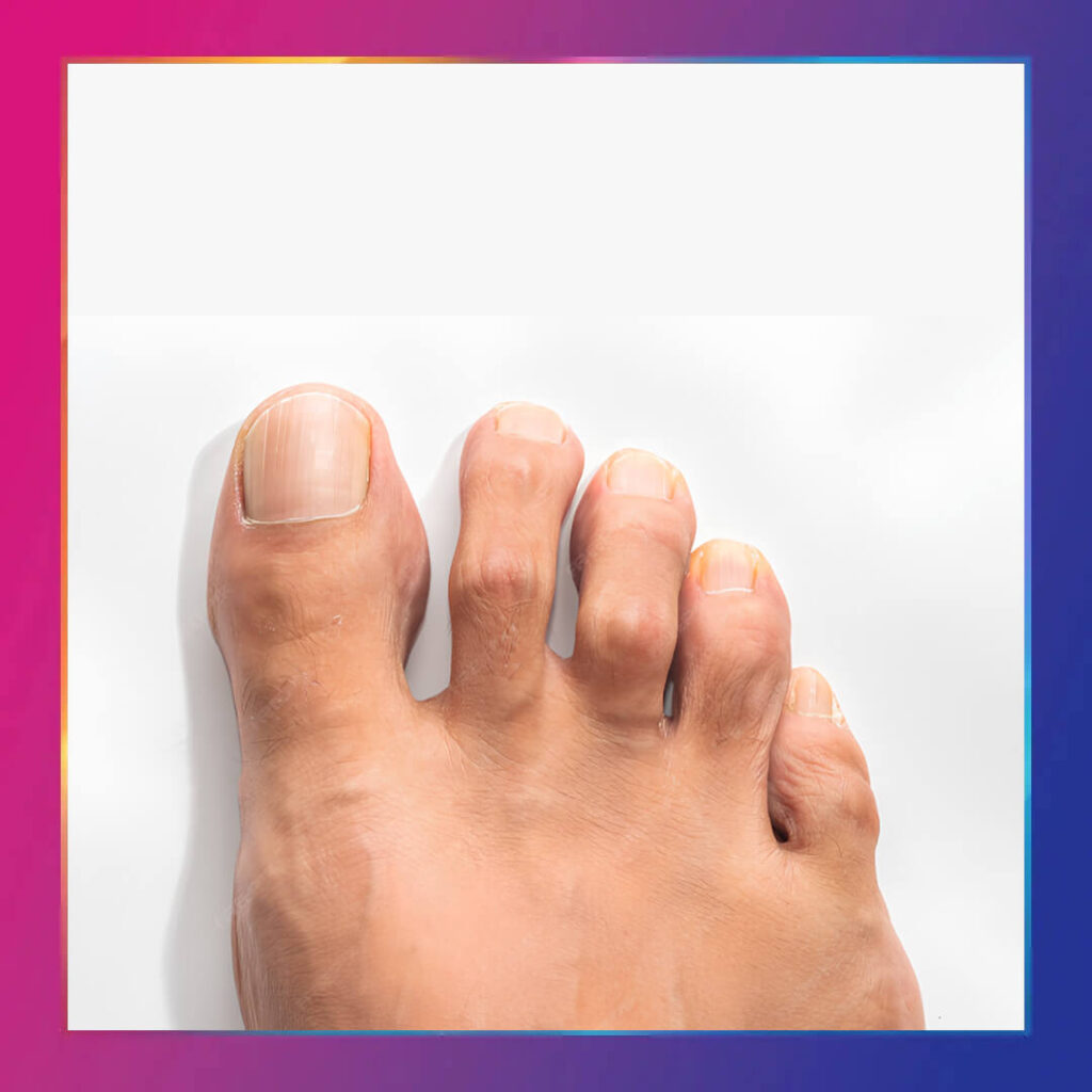 Çekiç parmak deformitesi proloterapi