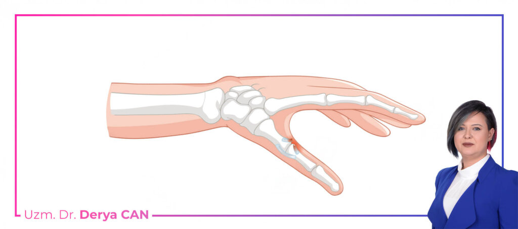 Başparmak Artriti tedavisi nasıl yapılır