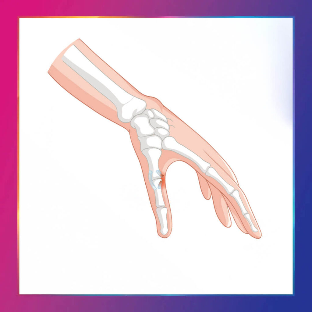 Başparmak Artriti nedir ve tedavisi