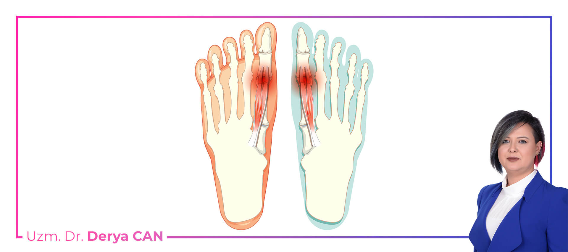 Başparmak Artriti neden olur