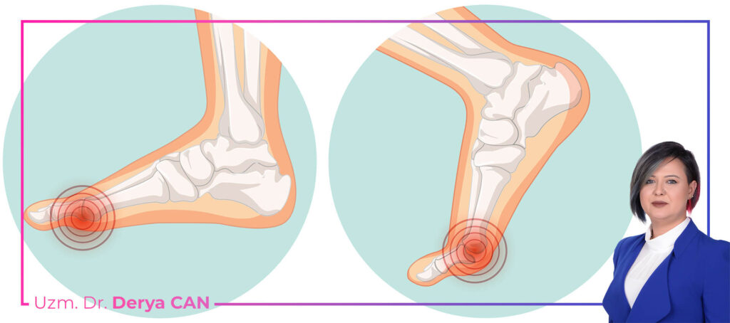 Halluks Limitus Tedavisi 1 Halluks limitus nedir ve belirtileri nelerdir
