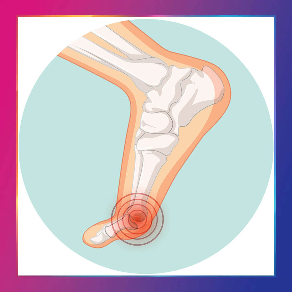 Halluks limitus tedavisi ve tedavi yöntemleri
