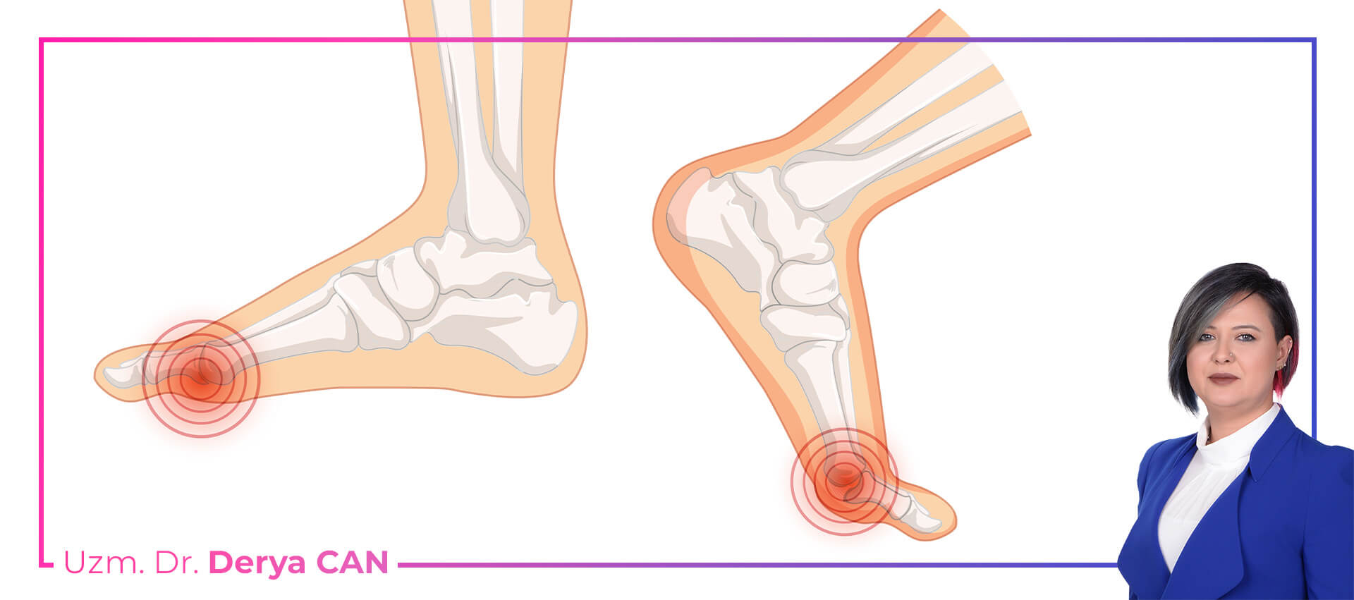 Halluks Limitus Tedavisi 3 Halluks limitus tedavisi nasıl yapılır - Dr Derya Can