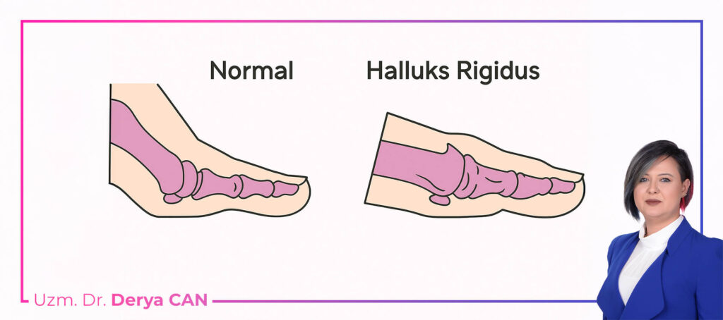 Halluks Rigidus (Sert Ayak Başparmağı) Tedavisi 1 Halluks Rigidus - Sert Ayak Baş Parmağı Nedir