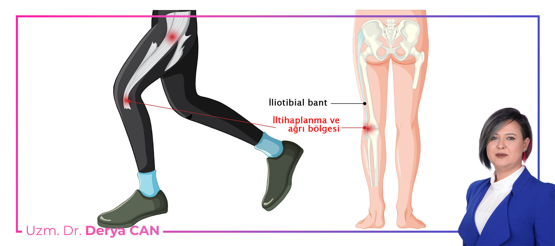 İliotibial bant sendromu neden olur