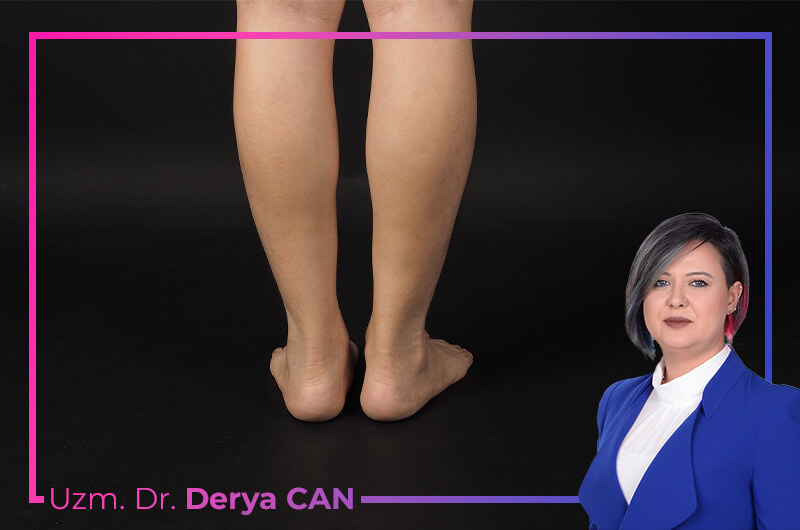 Lenfödem tedavisi nasıl yapılır