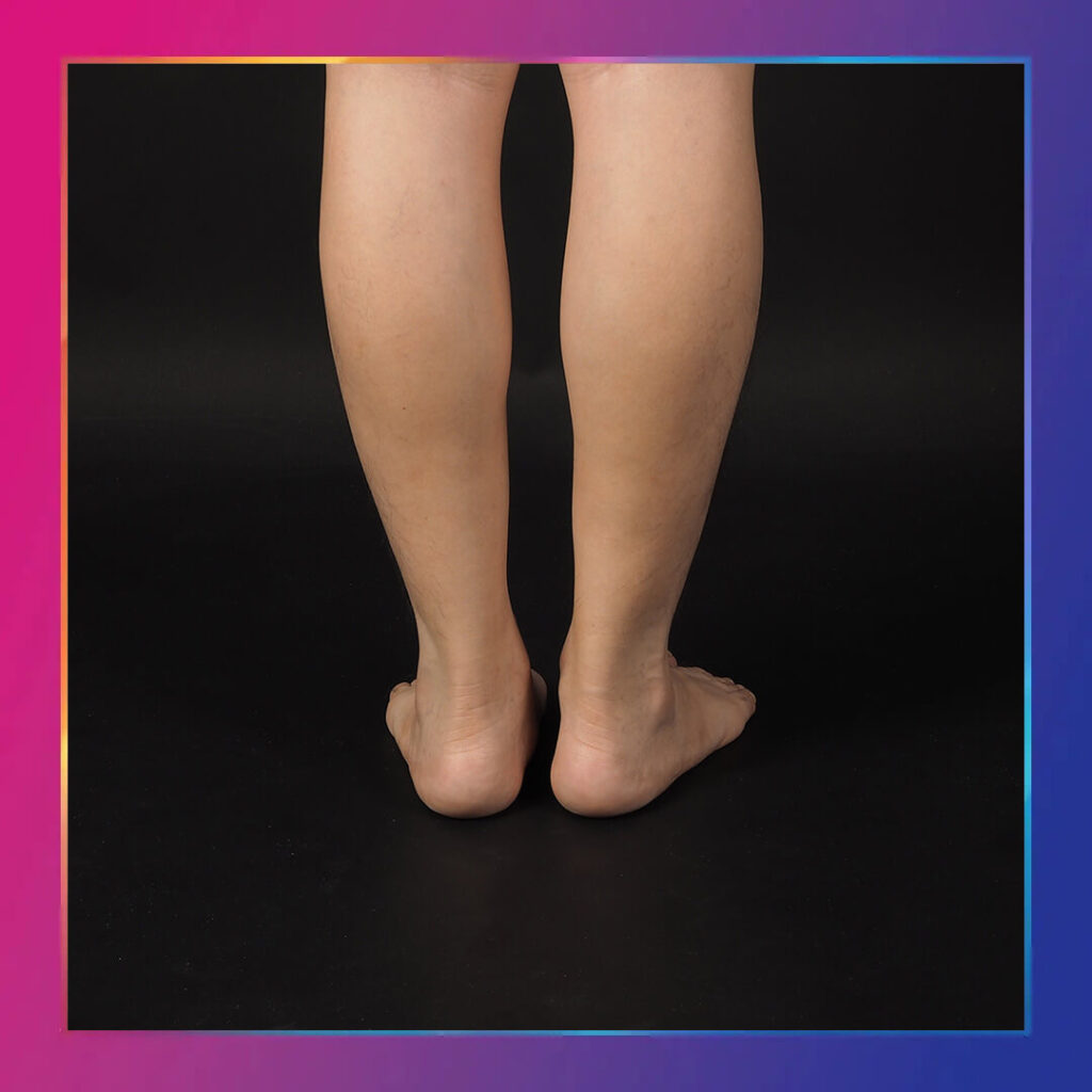 Lenfödem tedavisi Ankara