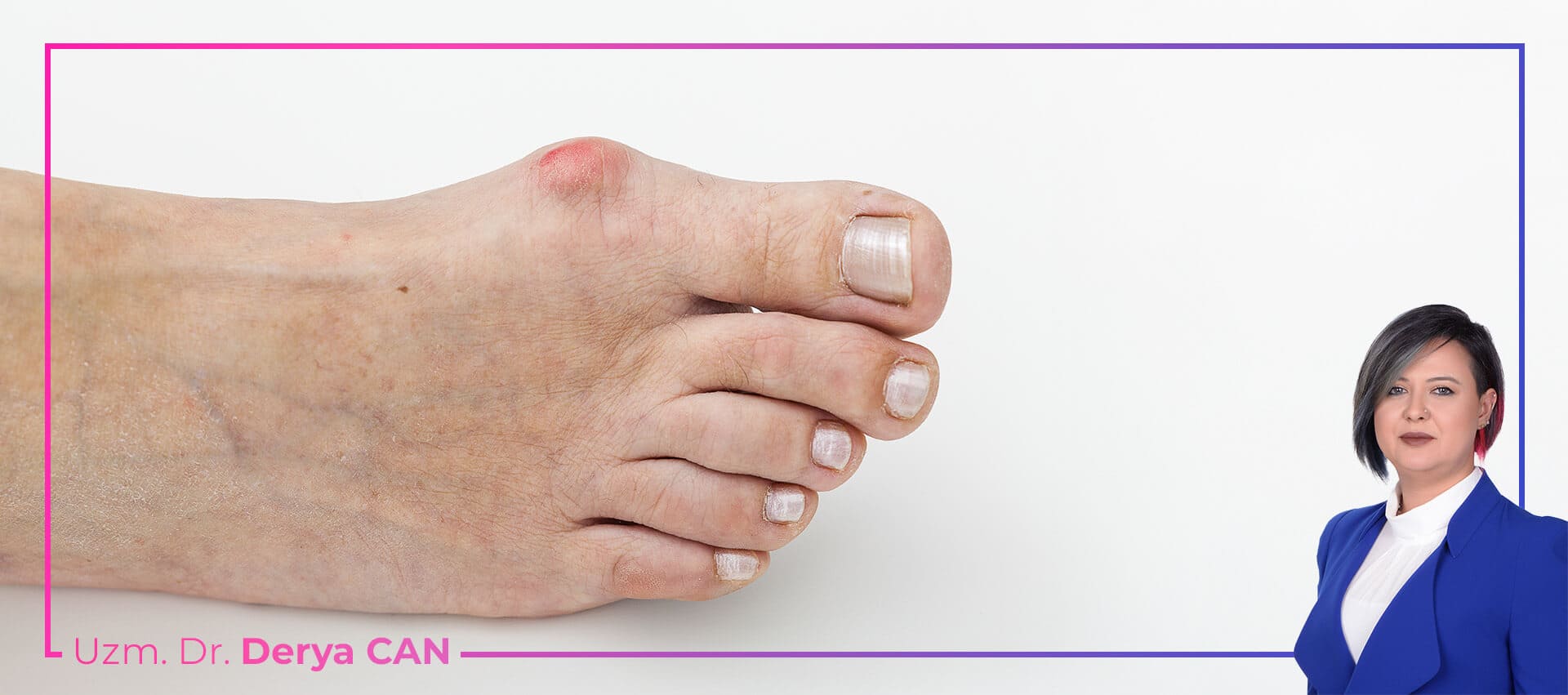 Halluks Rigidus (Sert Ayak Başparmağı) Tedavisi 3 Halluks Rigidus - Sert Ayak Baş Parmağı Tedavisi