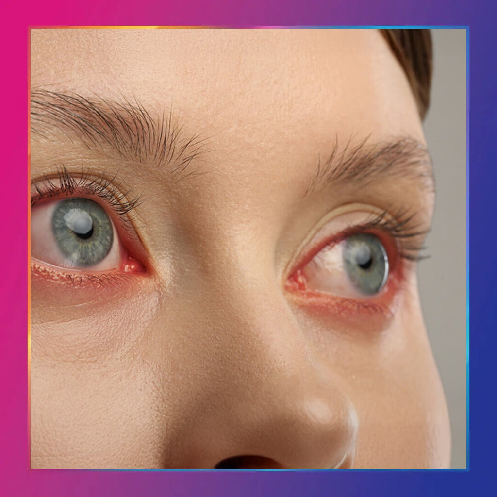 Göz nezlesi nedir ve tedavileri nelerdir