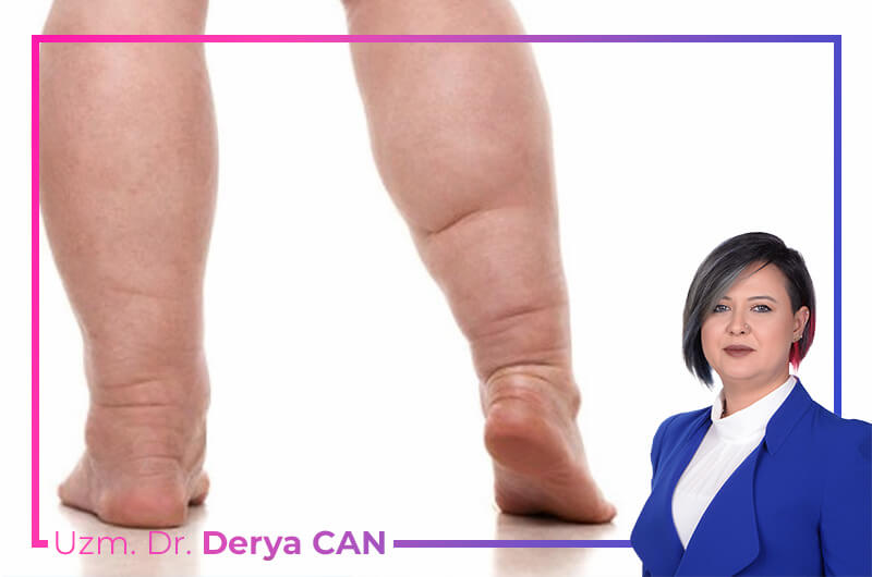 Lenfödem Tedavisi Ankara Maidan