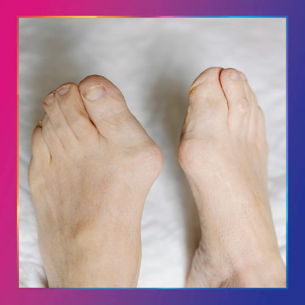 Terzi Ayağı (Bunyonet) Tedavisi - Dr. Derya Can