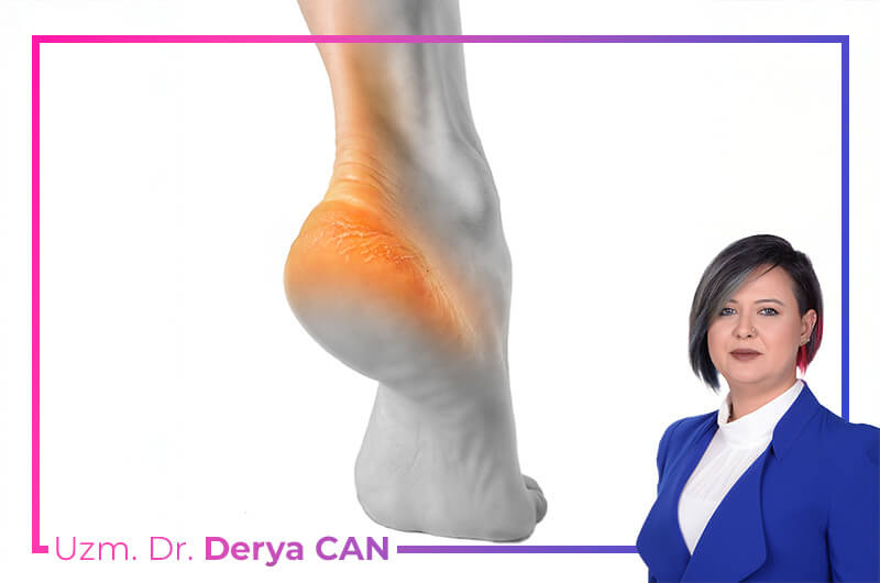 Topuk Bursit tedavisi, nedenleri, belirtileri