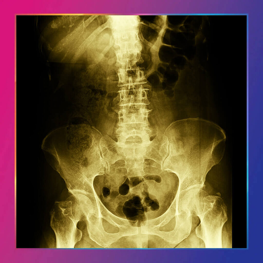 Spondilolizis Tedavisi Dr. Derya Can