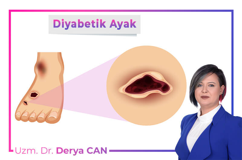 Diyabetik ayak yarası bilgilendirici görsel