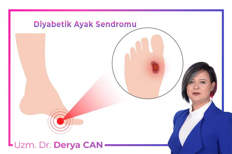 Diyabetik ayak yarası nedir ve tedavileri