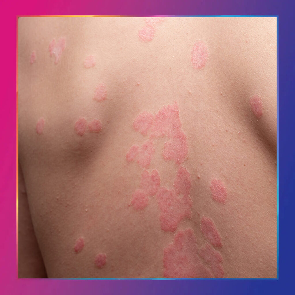 Ürtiker - kurdeşen kapak fotoğrafı