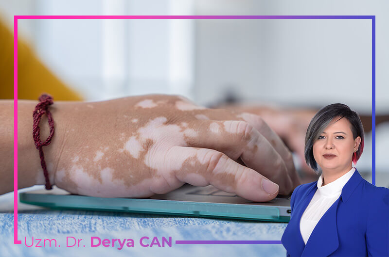Vitiligo Nedir? Belirtileri ve Tedavi Yöntemleri Nelerdir? 3 Vitiligo tedavisinde serum ozon - Ankara