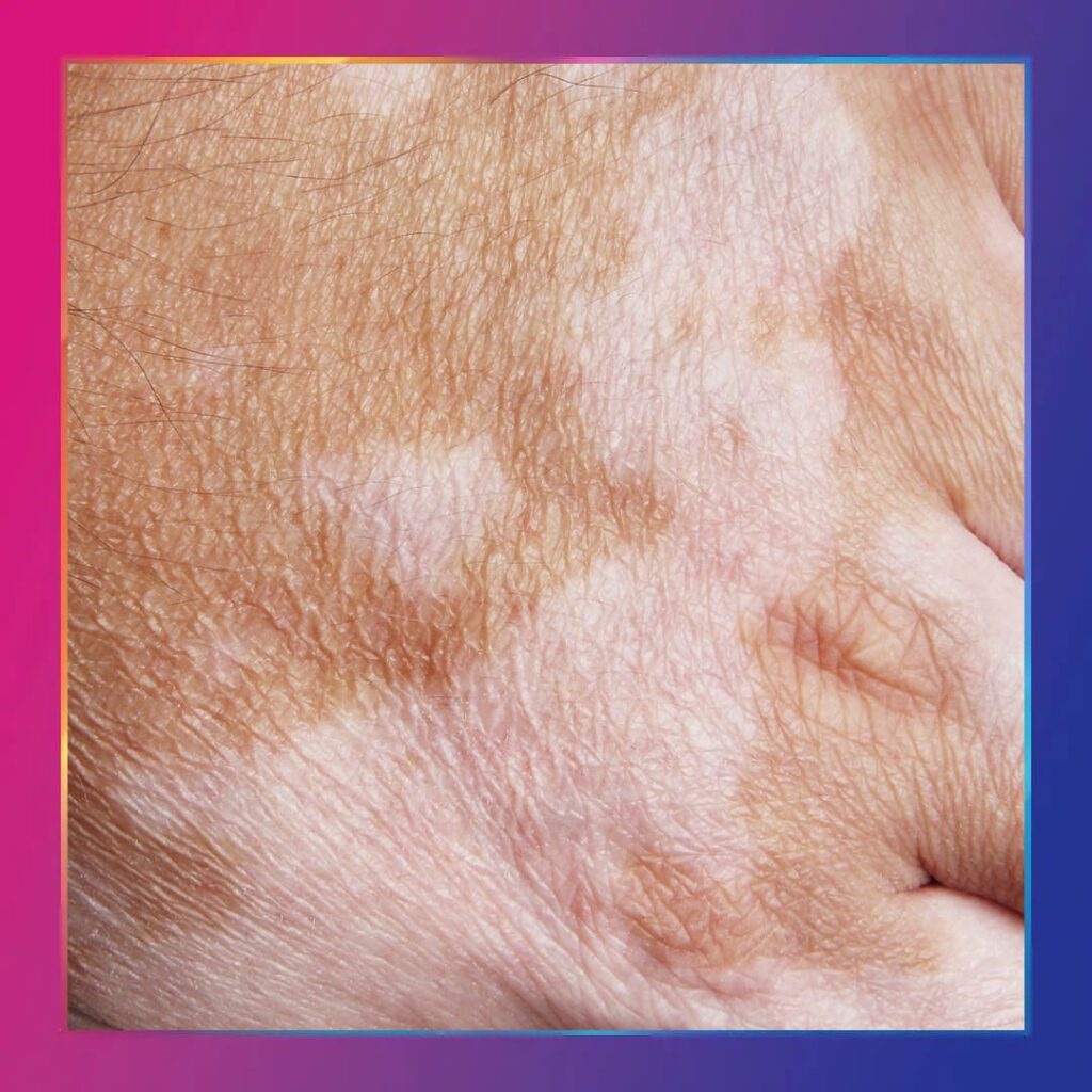 Vitiligo tedavisi kapak görseli