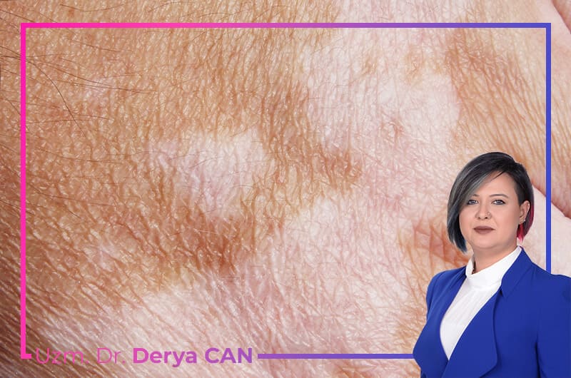 Vitiligo Nedir? Belirtileri ve Tedavi Yöntemleri Nelerdir? 2 Vitiligo tedavisi Ankara - Dr. Derya Can
