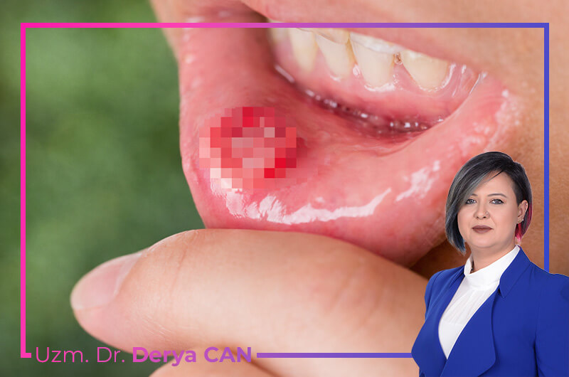 Behçet Hastalığı Nedir? 6 Behçet Hastalığı Belirtileri ve Tedavisi 2 Behçet hastalığı tedavisi görseli