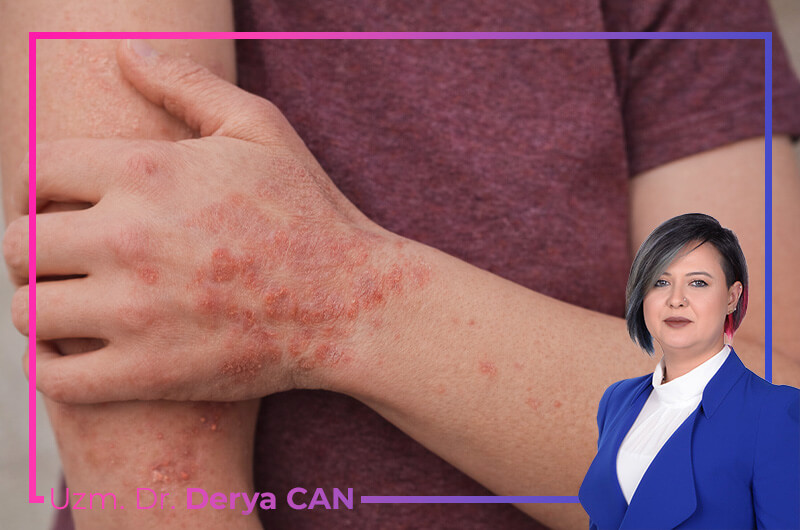 Behçet Hastalığı Nedir? 6 Behçet Hastalığı Belirtileri ve Tedavisi 1 Behçet hastalığı nedir anlatan görsel