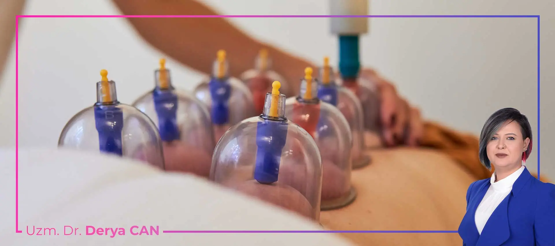 Hacamat Altın Günü Nedir? 7 Hacamat Faydaları Nelerdir? Kupa Tedavisi Nasıl Yapılır? Migren, Baş ağrısı, Altın hacamat günü, Uzm Dr Derya Can