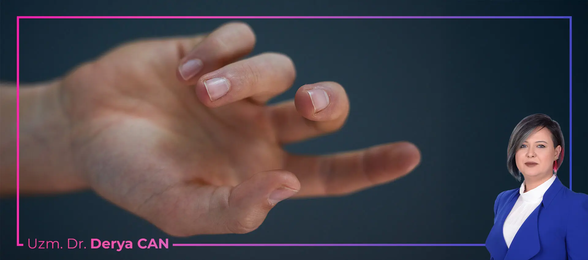 Tetik parmak sendromunda görülen şişlik ve parmakta hareket kısıtlılığı