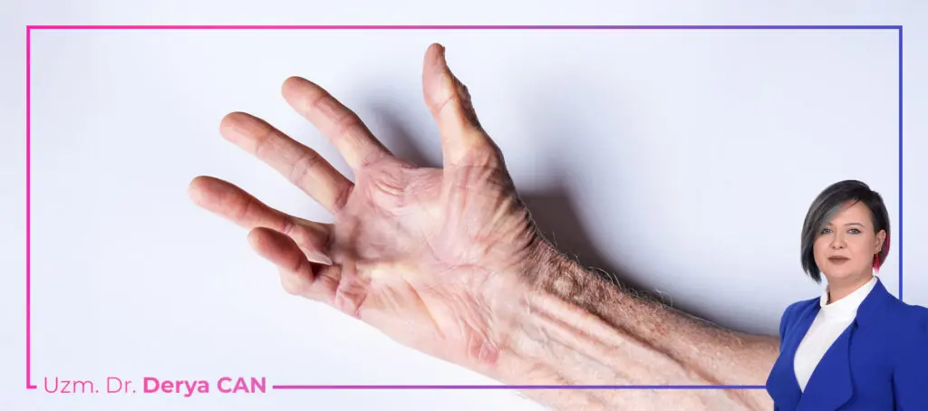 Dupuytren nedir ve belirtileri nelerdir?