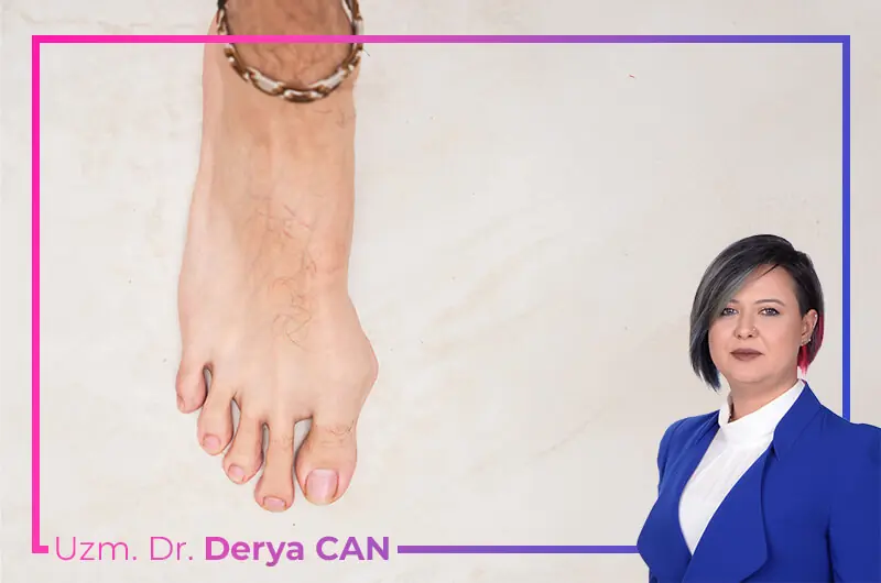Halluks Valgus (Başparmak Çıkıntısı) Nedir ve Belirtileri Nelerdir?