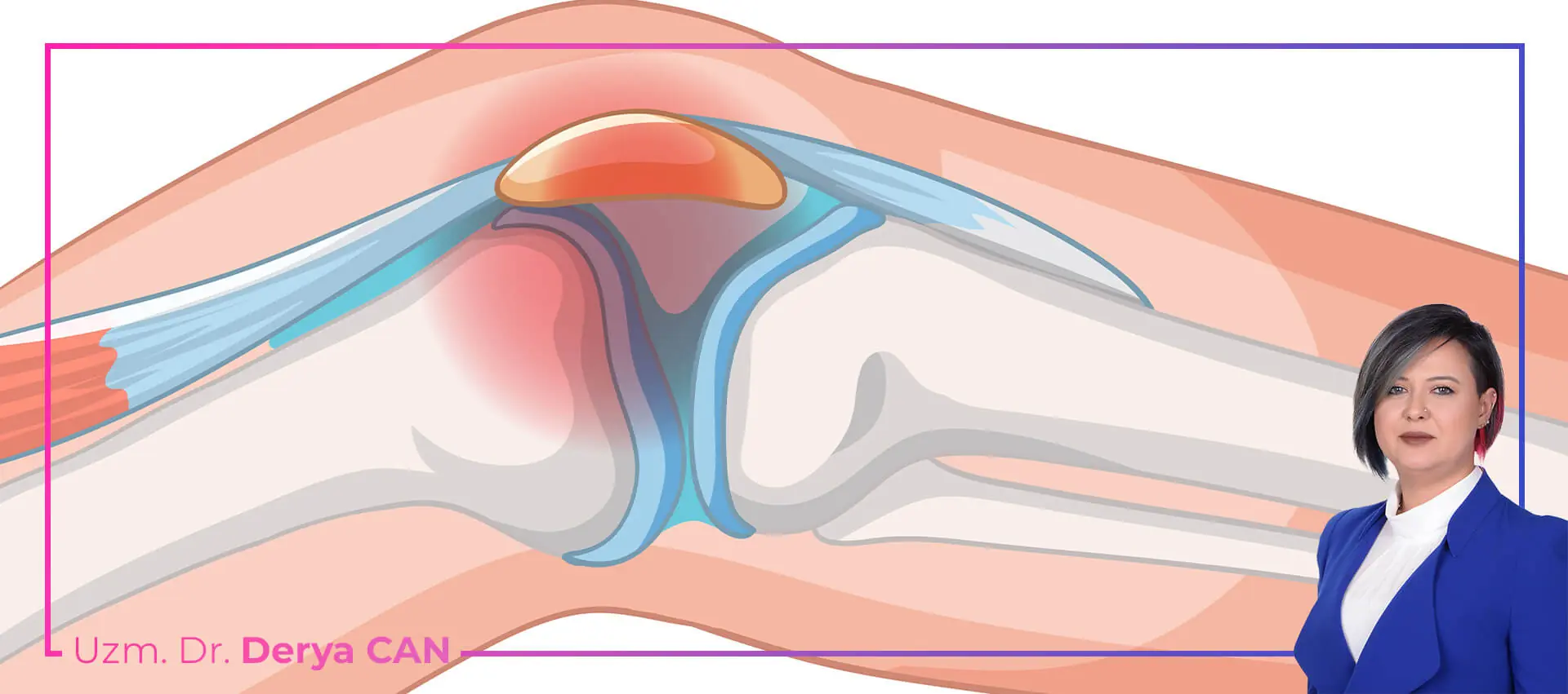 Avasküler Nekroz (Osteonekroz) Nedir