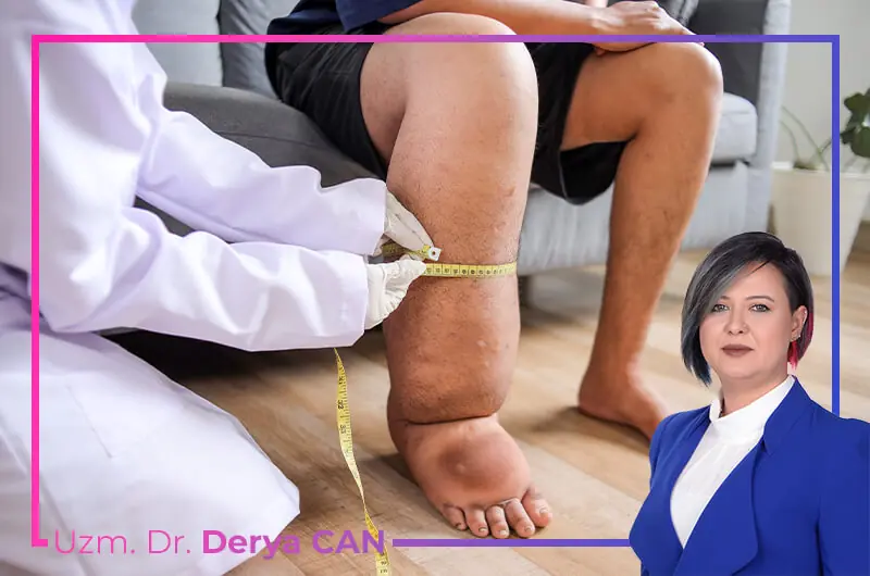 Lenfödem Tedavisi 2 Lenfödem nedir ve belirtileri nelerdir