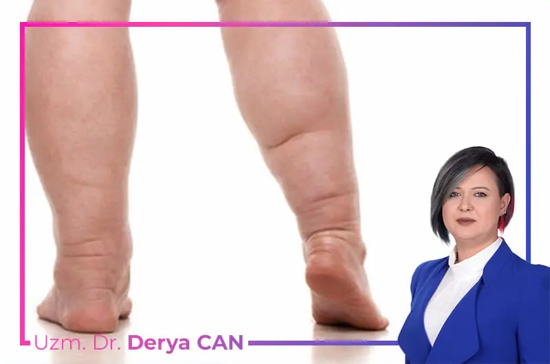 Lenfödem Tedavisi 1 Lenfödem Tedavisi Ankara Maidan