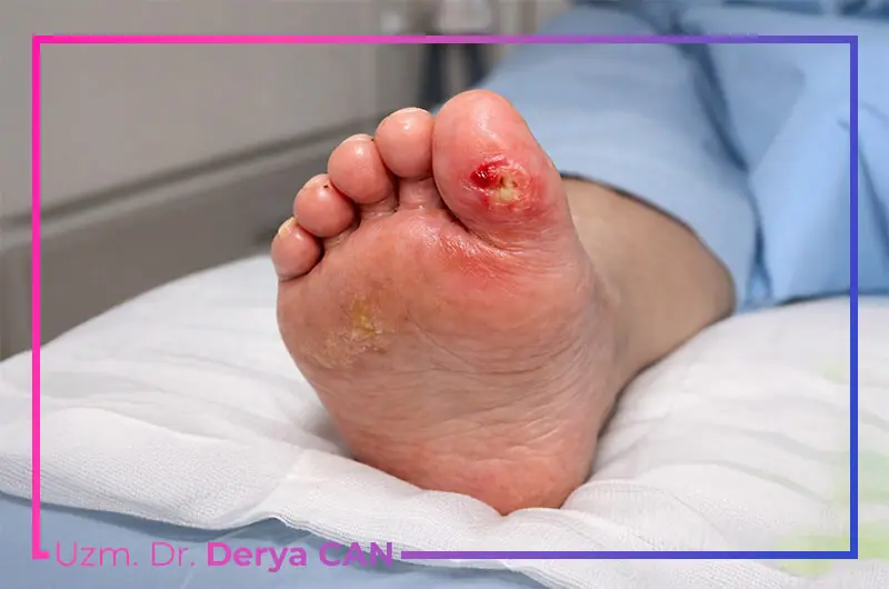 Diyabetik ayak ileri seviye görseli
