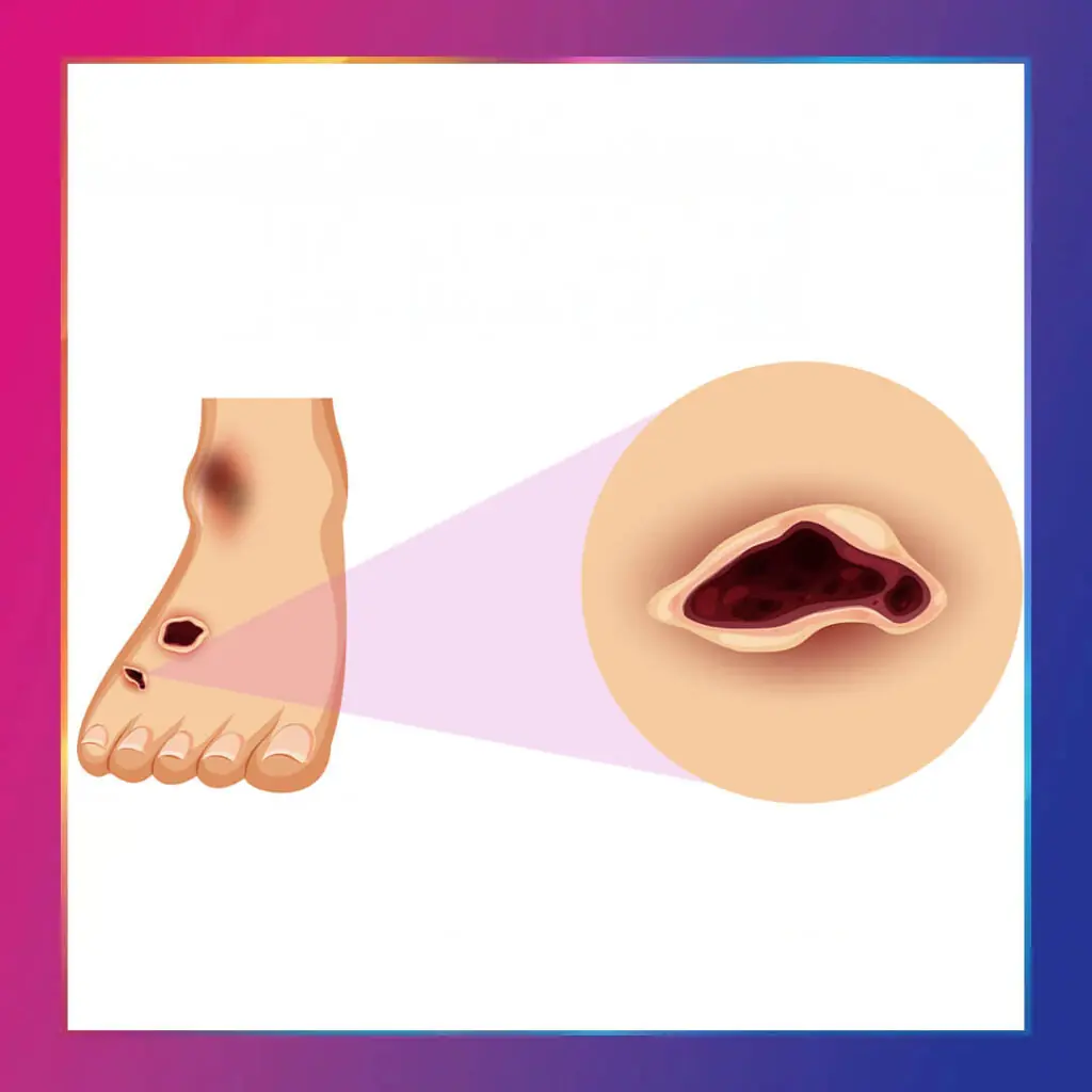 Diyabetik ayak tedavisi kapak görseli