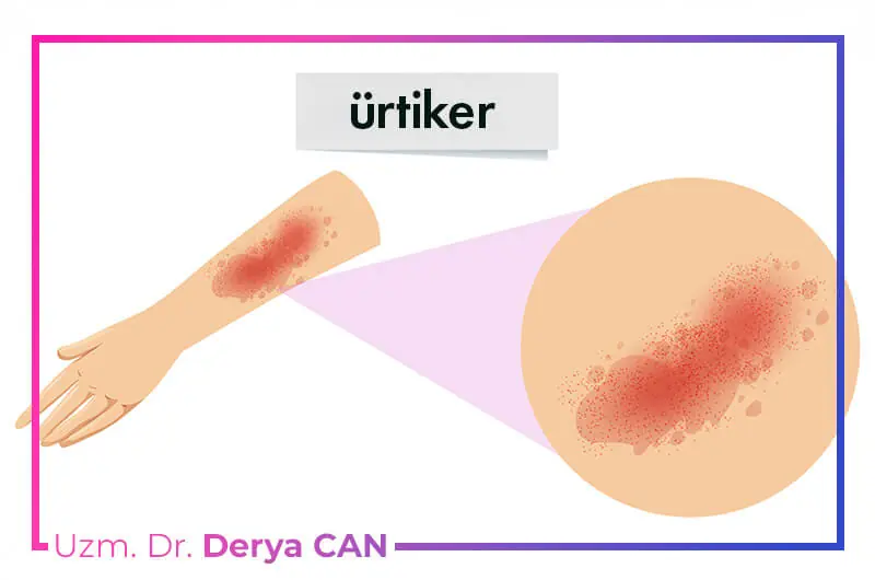 Ürtiker (Kurdeşen) Nedir? Nasıl Tedavi Edilir? 2 Ürtiker nedir ve nasıl tedavi edilir