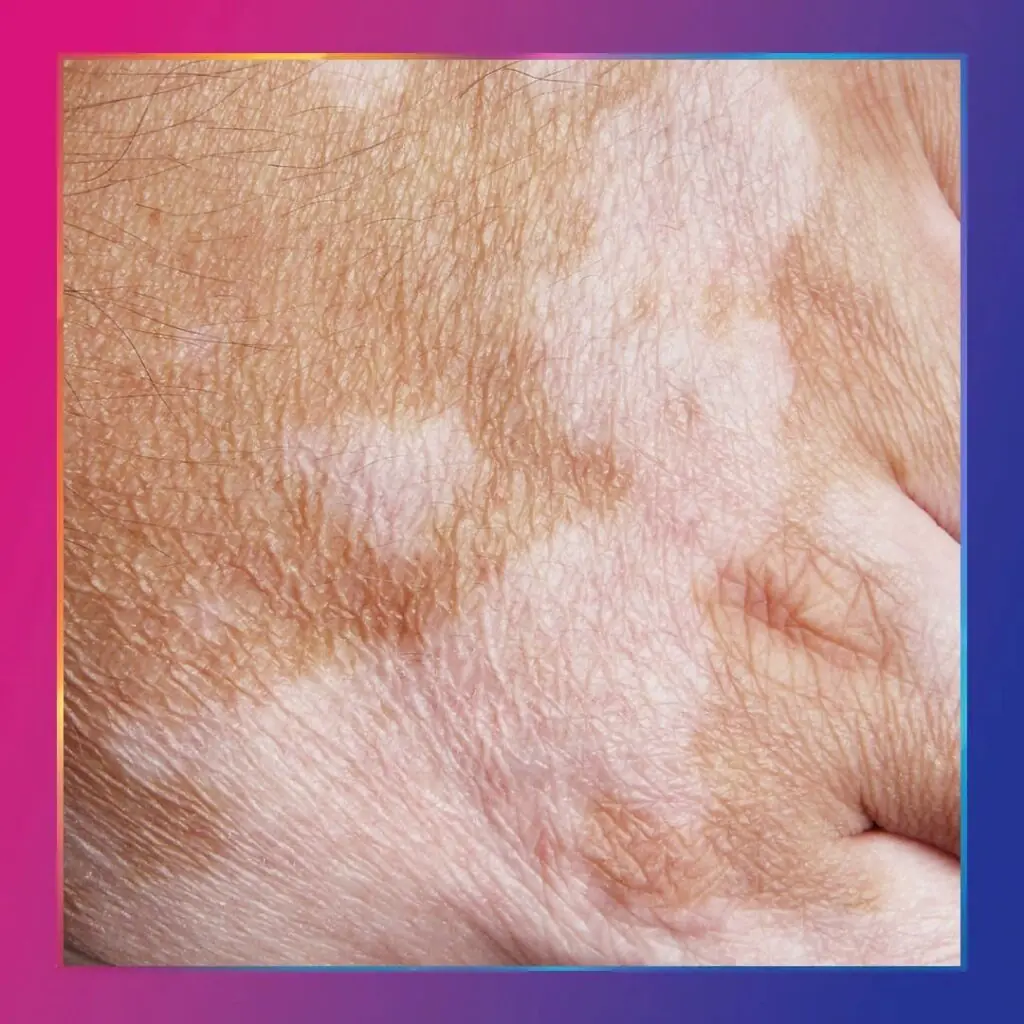 Vitiligo tedavisi kapak görseli