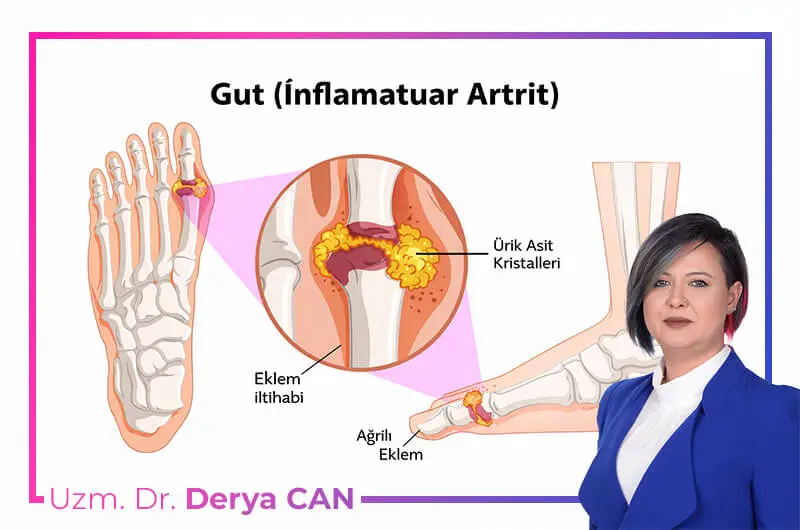 Gut hastalığı nedir illustrasyonu