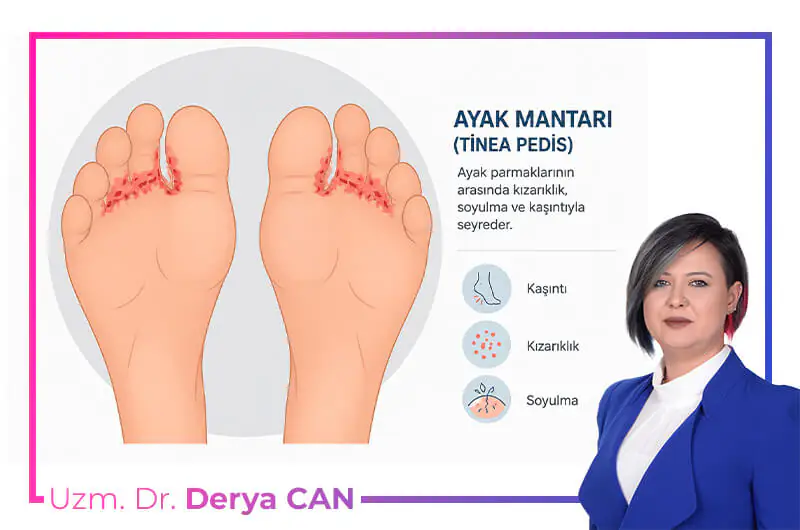 Ayak Mantarı Tedavisi Nedir? Ayak Mantarına Ne İyi Gelir? 2 Ayak mantarı tedavisi nasıl yapılır - anlatımlı görsel