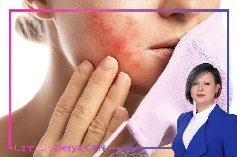Rosa Hastalığı Tedavisi 2 Rosa hastalığı nasıl tedavi edilir?